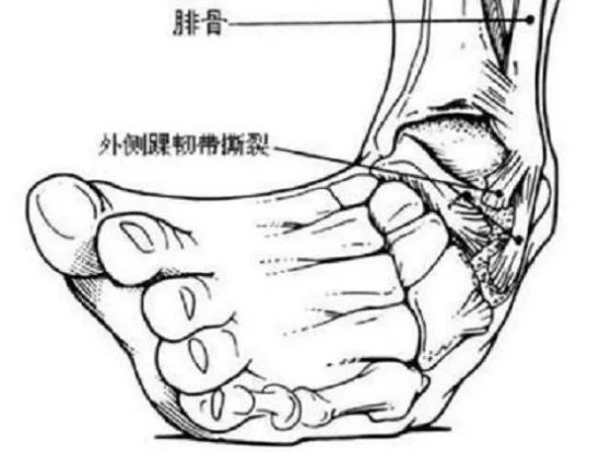 图片[3]-【健康知识】踝关节扭伤的处理方法