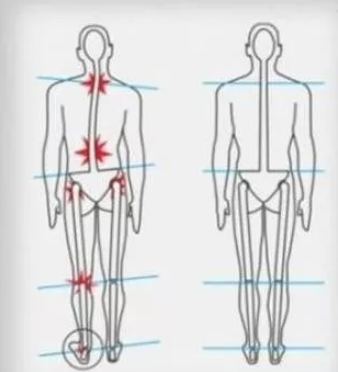 图片[4]-【健康知识】长短腿的隐患分析