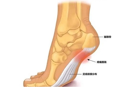 图片[1]-【健康知识】痛起来痛死人的足跟痛，调理需要注意哪些方面？
